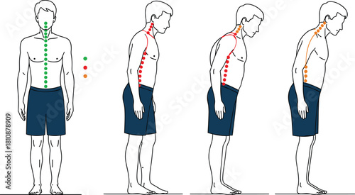 Vector illustration set showing male body posture analysis comparing correct green spine alignment against incorrect red hunchback and slouching positions for medical charts and diagrams.
