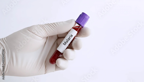 Doctor Hand Holding Malaria Blood Test Tube Sample with Purple Cap Isolated on White Background