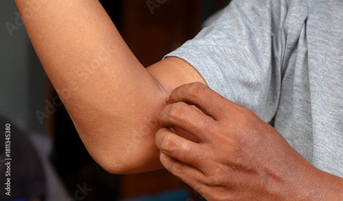 Foto Young asian man itching and scratching on arm from itchy dry skin eczema dermatitis
