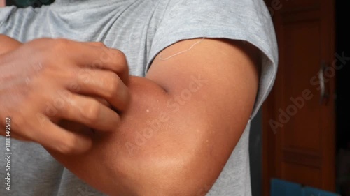 Young asian man itching and scratching on arm from itchy dry skin eczema dermatitis. Skin disease. Dermatological care. 