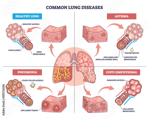 Healthy lung diagram shows lungs, alveoli, and bronchiole with comparisons to asthma, pneumonia, and COPD, explaining airway health at a glance. Outline diagram
