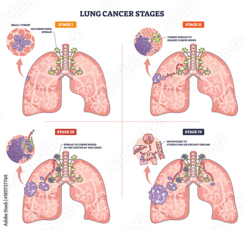 Lung cancer stages presented in a brief medical graphic, lungs, tumors, and lymph nodes show progression from Stage I to IV with metastasis. Outline diagram
