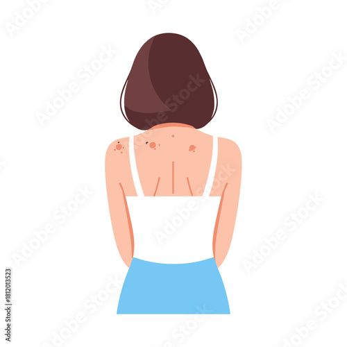 Woman with rash on back standing with hands behind in simple style  
