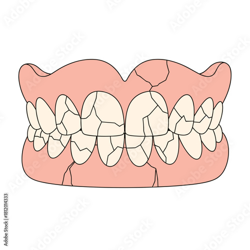 Cracked dentures showing damaged teeth in dental illustration  