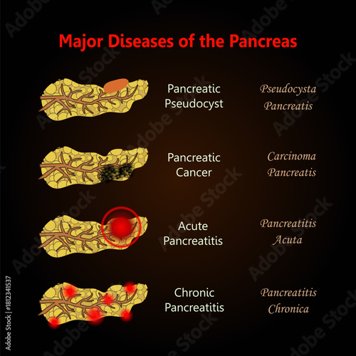Major Diseases of the Pancreas, early signs of pancreatic cancer