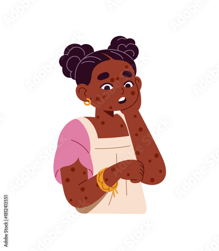Black little girl with rash on body, chickenpox. Ill kid with chicken pox, allergic spots on skin. Sick child with measles, smallpox virus. Flat isolated vector illustration on white background