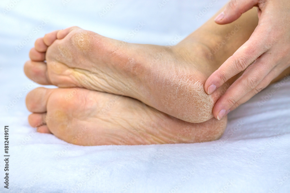 Fototapeta premium Female feet dry skin on the heels. Selective focus.