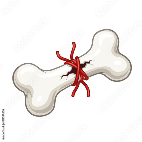 Vector illustration of a cracked bone tied with red cord, symbolizing fractures, trauma, osteoporosis, medical research, and health science. Ideal for educational and healthcare content