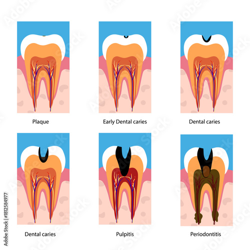 Hand-drawn dental infographic illustrating tooth anatomy and stages of cavity development. Educational medical illustration showing enamel, dentin, pulp, plaque, and decay progression