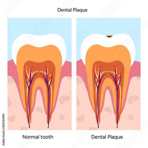 Hand-drawn dental infographic illustrating the formation of dental plaque on tooth anatomy. Includes enamel, dentin, pulp, gum line, and bacterial buildup area