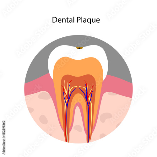 Hand-drawn dental infographic illustrating the formation of dental plaque on tooth anatomy. Includes enamel, dentin, pulp, gum line, and bacterial buildup area
