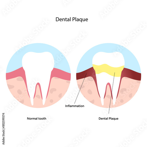 Hand-drawn dental infographic illustrating the formation of dental plaque on tooth anatomy. Includes enamel, dentin, pulp, gum line, and bacterial buildup area