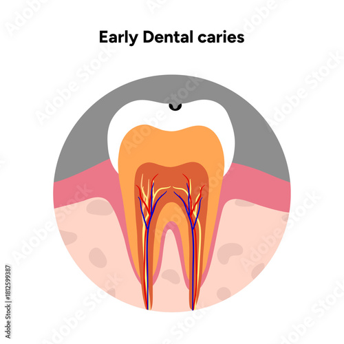 Hand-drawn dental infographic illustrating tooth anatomy and stages of cavity development. Educational medical illustration showing enamel, dentin, pulp, plaque, and decay progression