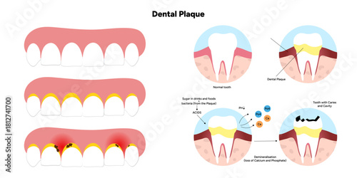 Hand-drawn dental infographic illustrating the formation of dental plaque on tooth anatomy. Includes enamel, dentin, pulp, gum line, and bacterial buildup area