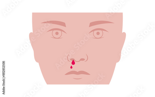 Nosebleed medical poster