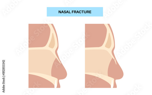 Nasal fracture poster