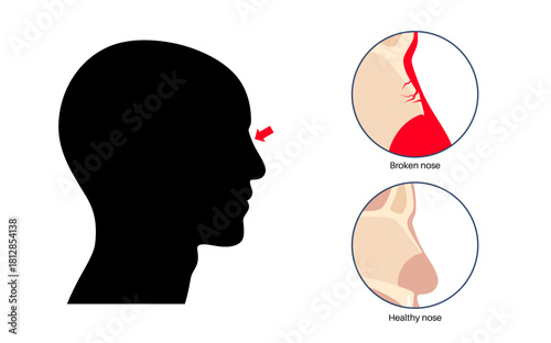 Nasal fracture poster