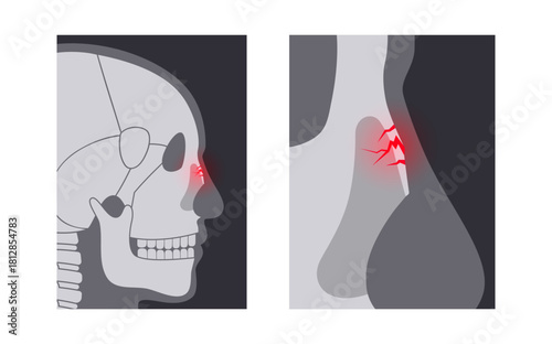 Nasal fracture poster