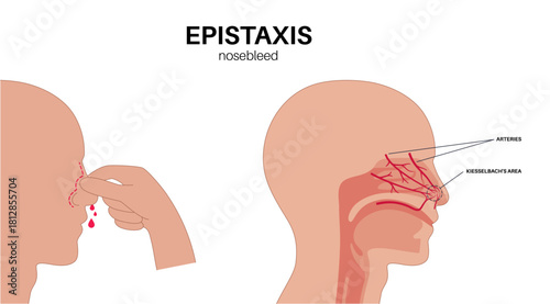 Stop nosebleed instruction