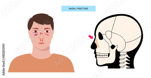 Nasal fracture poster