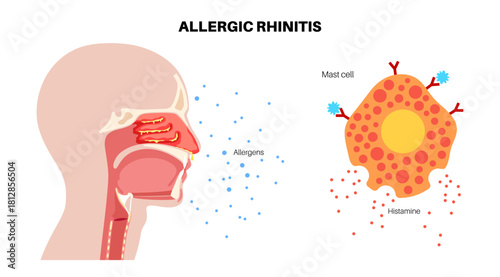 Allergic rhinitis poster