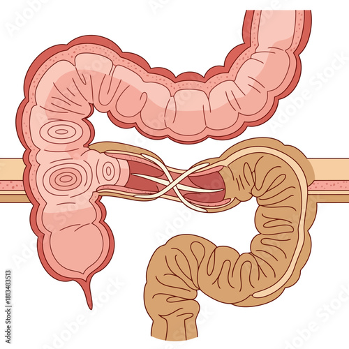 Anatomical Illustration of Intussusception in the Human Intestine Showing Bowel Telescoping