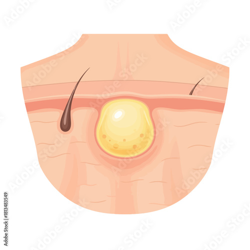 Close-up Illustration of a Pimple with Pus and Hair Follicles in Human Skin Layers