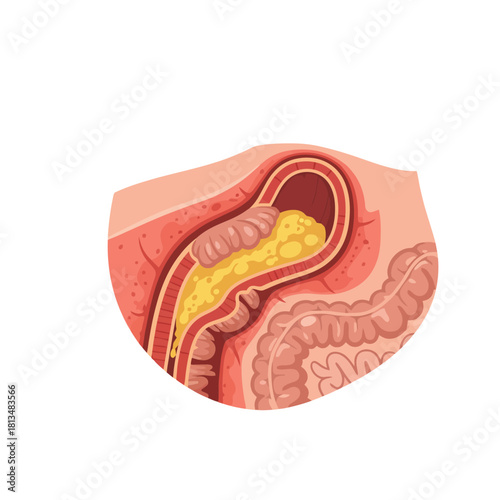 Cross Section of Intestine Showing Diverticulitis with Fecal Material and Inflammation