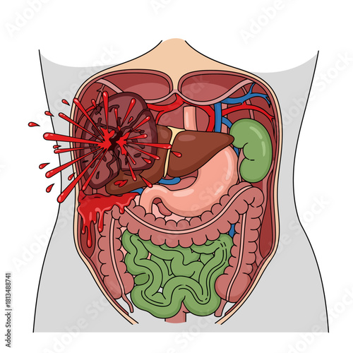 Detailed Medical Illustration of a Ruptured Spleen in Human Abdomen Causing Internal Bleeding