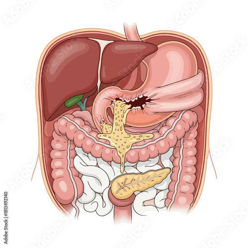 Illustration of a Perforated Stomach with Leaking Contents in Human Abdominal Cavity