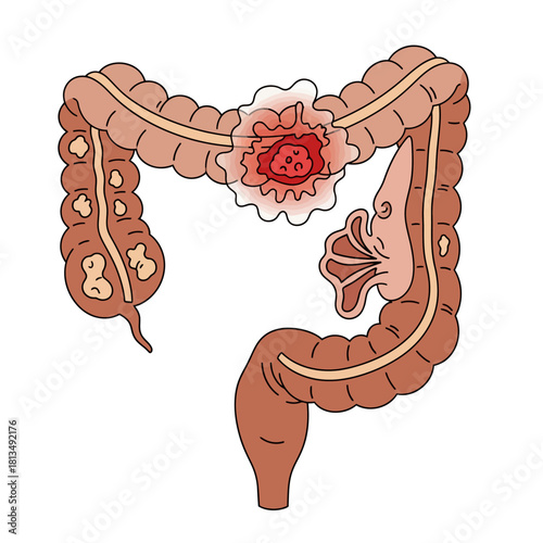 Illustration of a diseased colon showing polyps and a tumor with inflammation