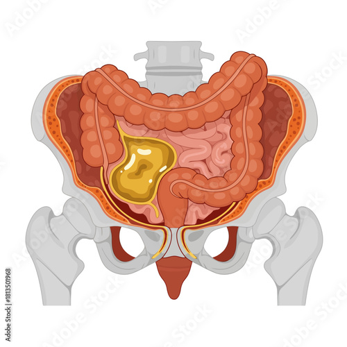 Medical illustration of human abdominal organs and pelvic anatomy highlighting an internal mass or