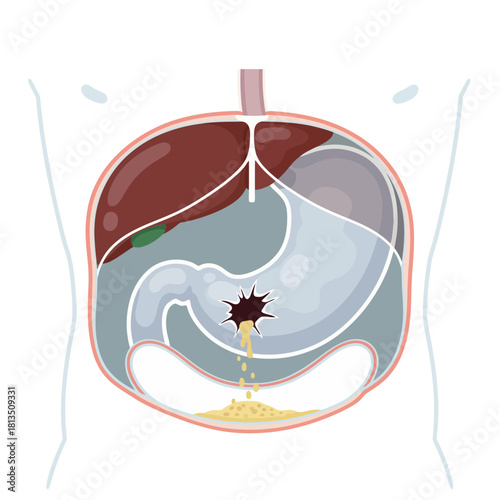 Perforated Stomach Illustration with Bile Leakage into Abdominal Cavity