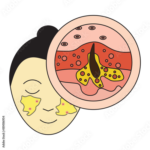 Oily Skin and Clogged Pores with Acne