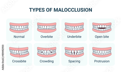 Types of Malocclusion and Normal Human Teeth, Frontal View. Vector Medical Infographic, Editable Outline.