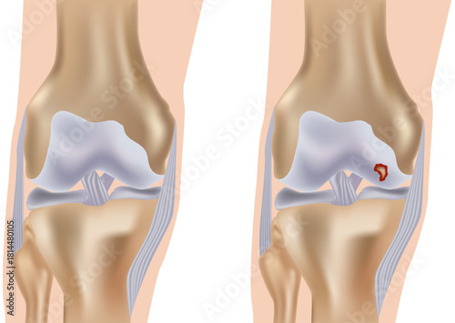 Detailed medical illustration comparing a healthy human knee joint with a joint affected by an articular cartilage lesion. Diagram of Knee Osteochondral Defect. Cartilage Damage