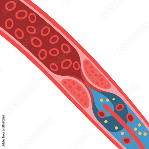 Illustration of atherosclerosis and blood flow through a narrowed artery