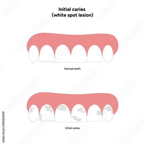 Hand-drawn dental infographic illustrating initial caries white spot lesion. Shows enamel demineralization, tooth layers, enamel surface changes, and early-stage decay. 