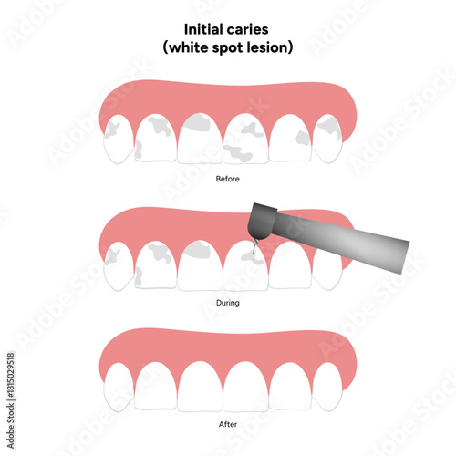 Hand-drawn dental infographic illustrating initial caries white spot lesion. Shows enamel demineralization, tooth layers, enamel surface changes, and early-stage decay. 