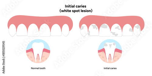 Hand-drawn dental infographic illustrating initial caries white spot lesion. Shows enamel demineralization, tooth layers, enamel surface changes, and early-stage decay. 