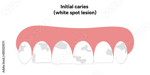 Hand-drawn dental infographic illustrating initial caries white spot lesion. Shows enamel demineralization, tooth layers, enamel surface changes, and early-stage decay. 