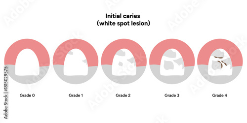 Hand-drawn dental infographic illustrating initial caries white spot lesion. Shows enamel demineralization, tooth layers, enamel surface changes, and early-stage decay. 