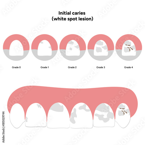 Hand-drawn dental infographic illustrating initial caries white spot lesion. Shows enamel demineralization, tooth layers, enamel surface changes, and early-stage decay. 