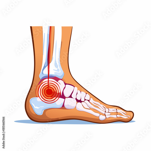Medical illustration of ankle pain showing the skeletal anatomy of a human foot with a radiating ache.