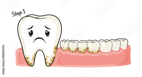 Sad tooth with plaque buildup at Stage 1 showing dental health issues, periodontal disease and gingivitis symptoms, emphasizing preventative care