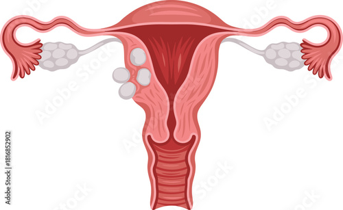 Vector illustration of female reproductive system showing uterus ovaries and fallopian tubes with uterine fibroids growing on the wall for gynecology and medical education.
