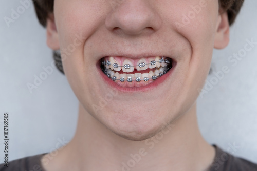 Close-up of a smiling young person with metal dental braces on their teeth. Orthodontic treatment, dental care and bite correction concept on a clean white background.