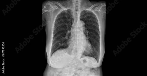 Foto Chest x-ray showing lungs, heart and thoracic cavity