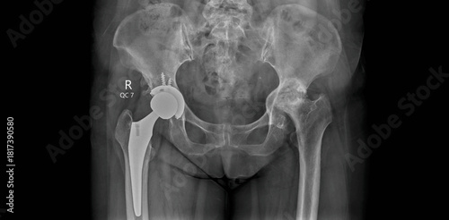 Pelvic x-ray showing hip replacement prosthesis. AP radiograph for postoperative examination of total hip arthroplasty with femoral stem and acetabular component