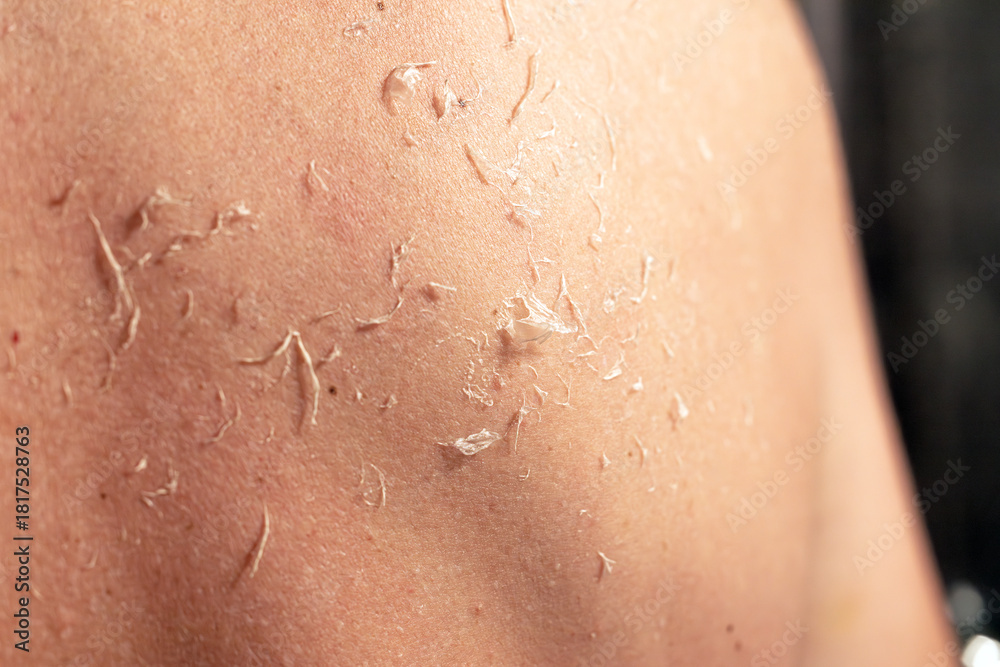 Fototapeta premium Sunburn, close-up of human skin. Peeling skin. Eczema.